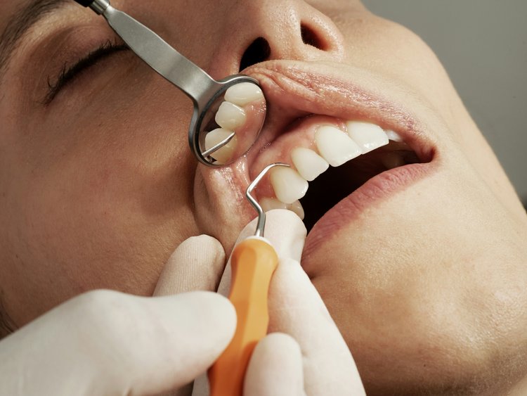 Dental Cleaning in Thornhill